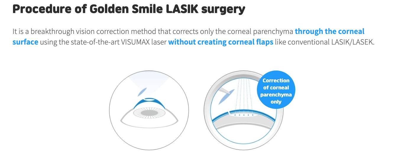 smile lasik, smile eye surgery review, Smile LASIK procedure