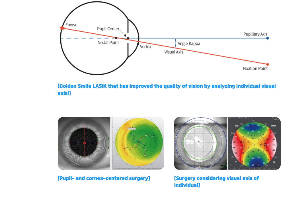 smile lasik, smile eye surgery review, Smile LASIK procedure