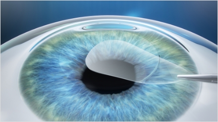 SMILE LASIK vs. LASIK: What’s the Difference? Eye Surgery in Korea!